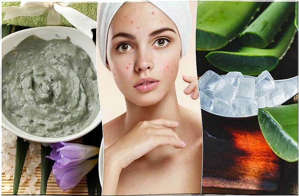 Acne on the face - 5 natural treatments