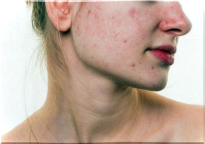 Acne on the face.