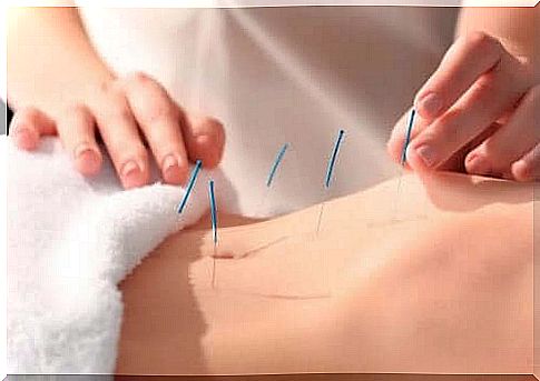 Acupuncture - inserted needles