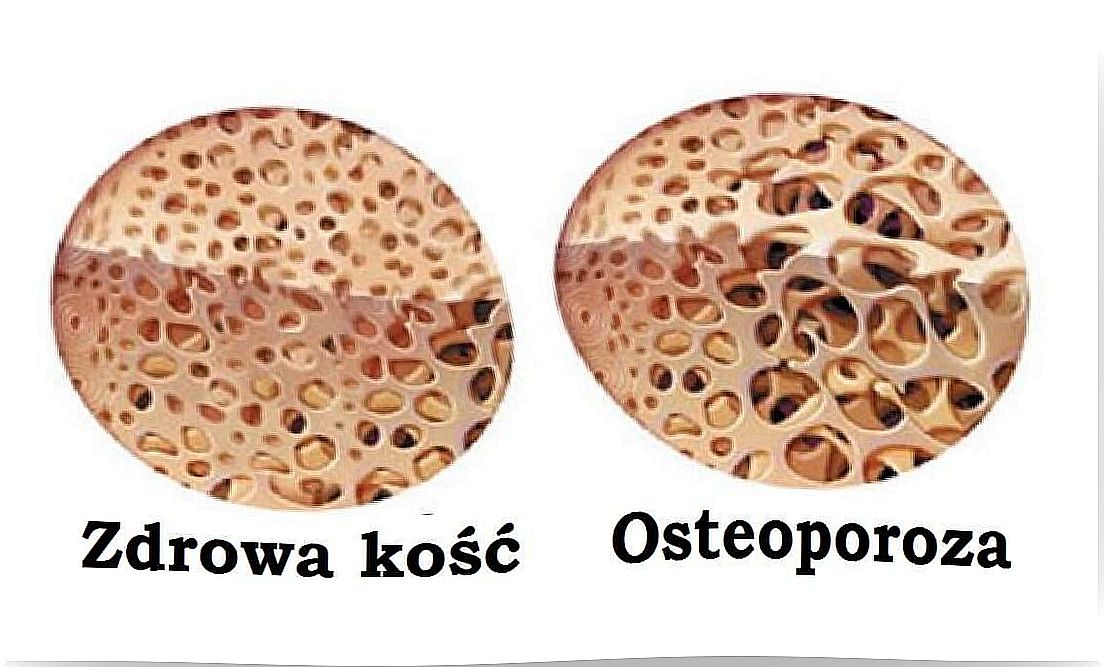 Bones and osteoporosis