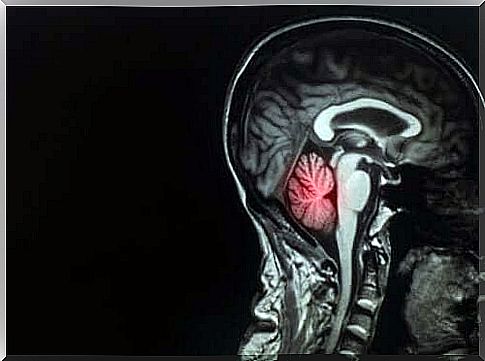 Brain metastases: description and treatment of this disease