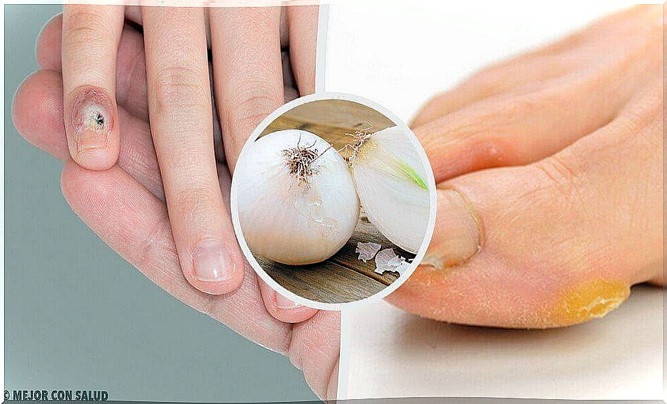 Callus - home remedies for removal