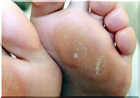 Calluses - three natural creams that will remove them!