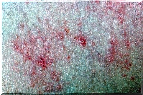 Candidiasis on the skin