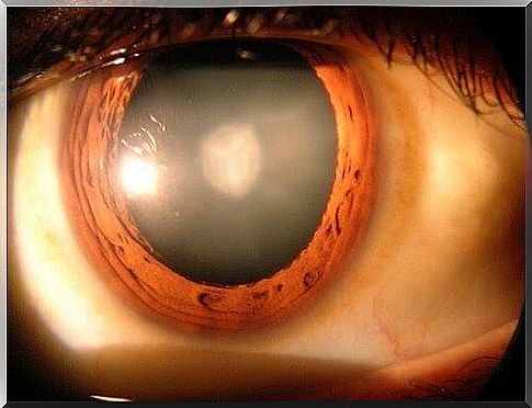 nuclear cataract treatment