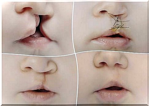 Cleft lip and palate - all there is to it