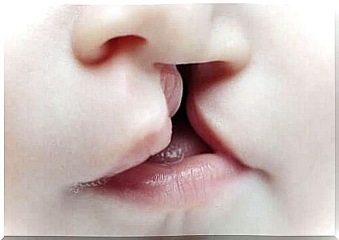 Cleft lip and palate