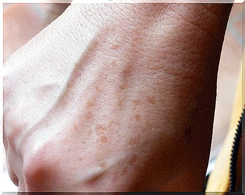 Discoloration on the hands - home remedies