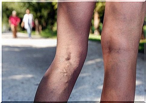 Exercises against varicose veins - a way to healthy legs