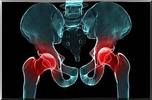 Hip dysplasia