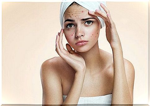 Girl with pimples and a towel on her head