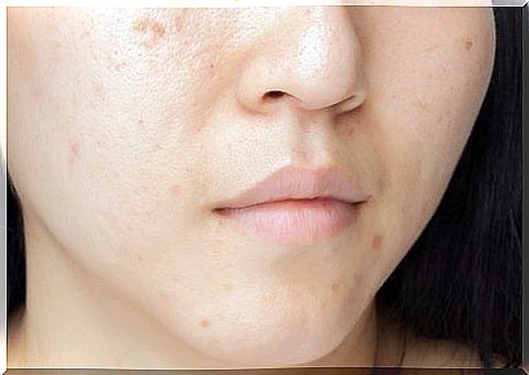 Dark spots on the face