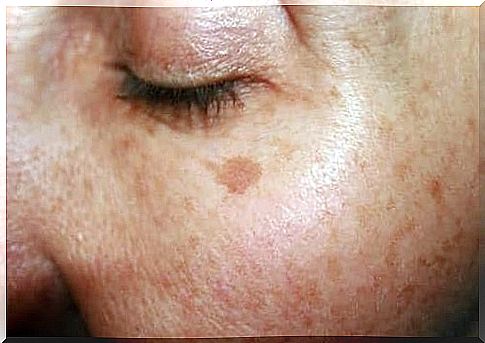 Dark spots on the face