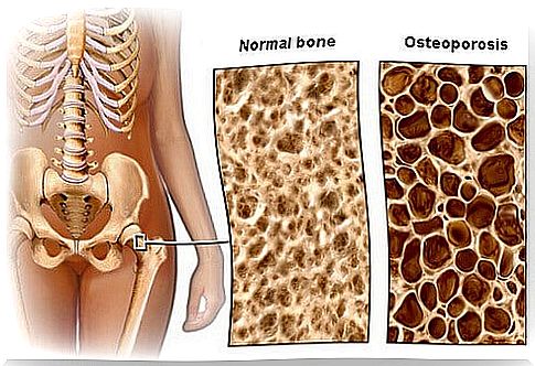 Find out about dietary advice to prevent osteoporosis