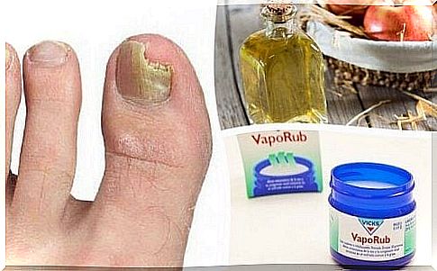 Nail fungus - 6 natural remedies