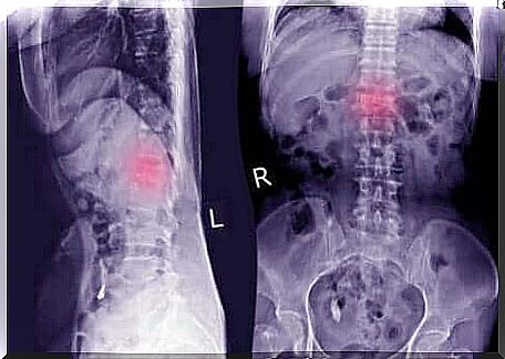 Picture of the spine