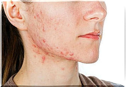 Tretinoin and acne: warnings and directions for use