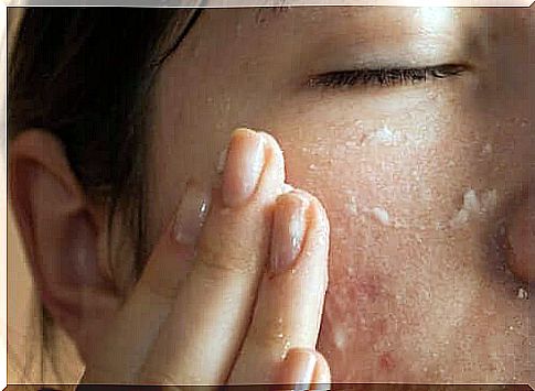 Acne on the face